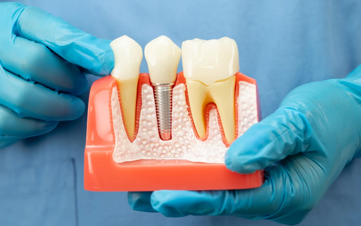 Dental Implants