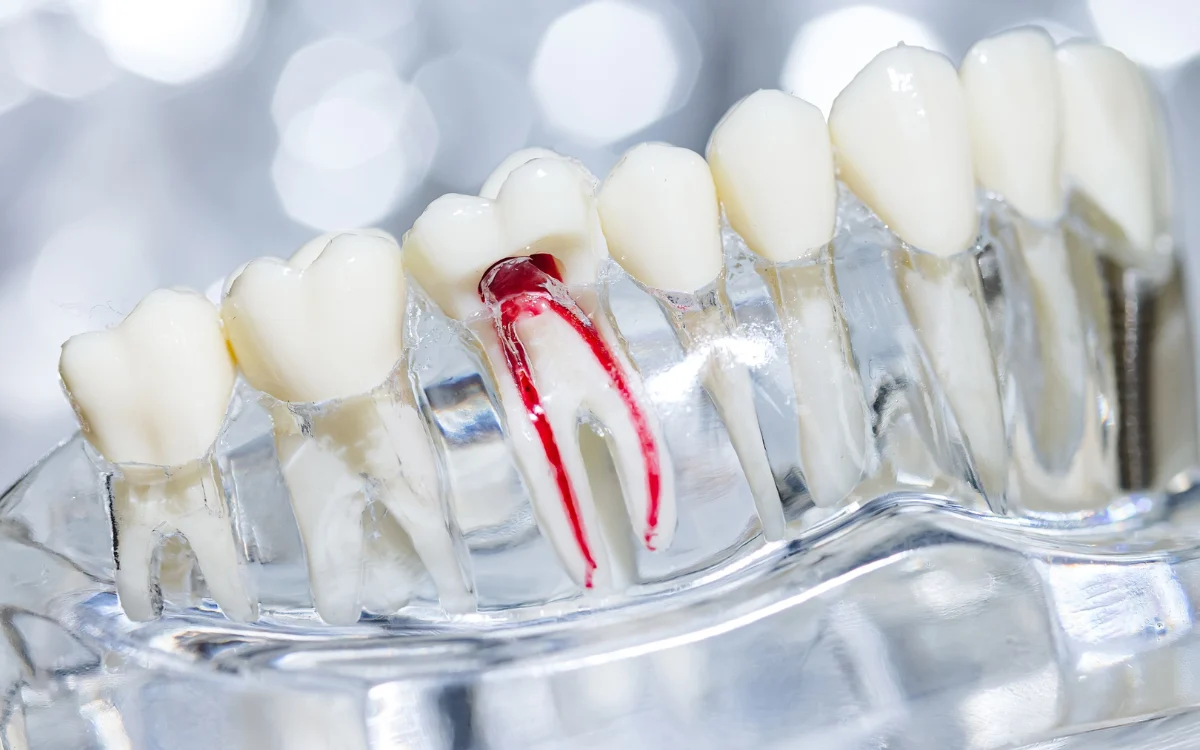 Root Canal Treatment